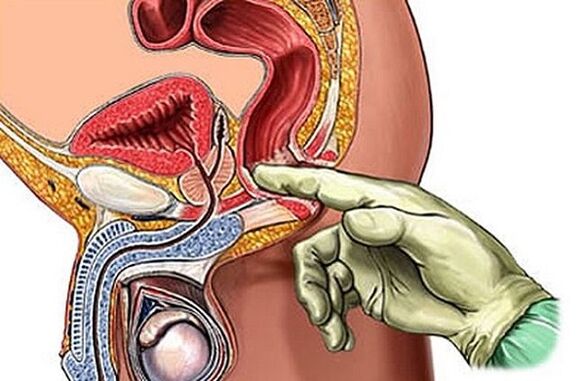 Prostata Massage als Wee fir Prostatitis ze behandelen
