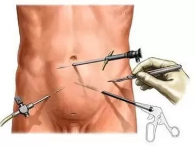 chirurgesch Behandlung vun chronescher Prostatitis