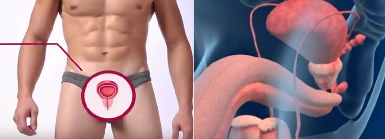 Prostatitis bei Männer, erkennbar duerch gewësse Schëlder