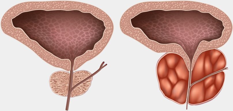 gesond an entzündegt Prostata mat Prostatitis