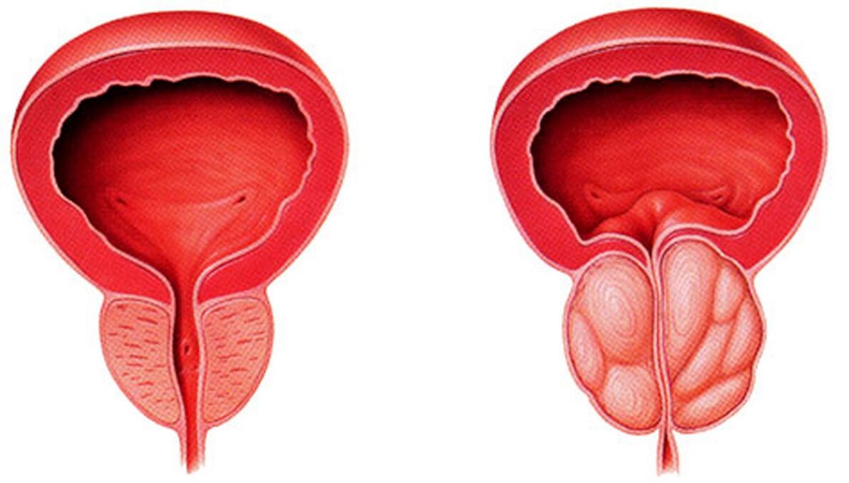 gesond an entzündegt Prostata mat Prostatitis