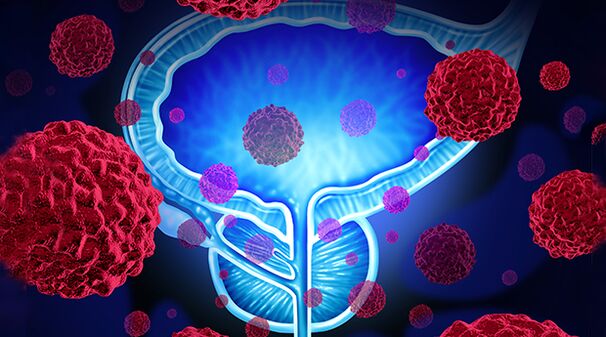 Bakterien als Ursaach vun der Prostatitis