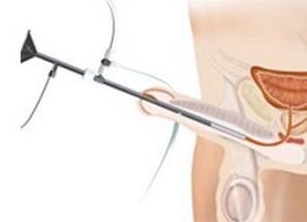 Instillatiounen fir Prostatitis