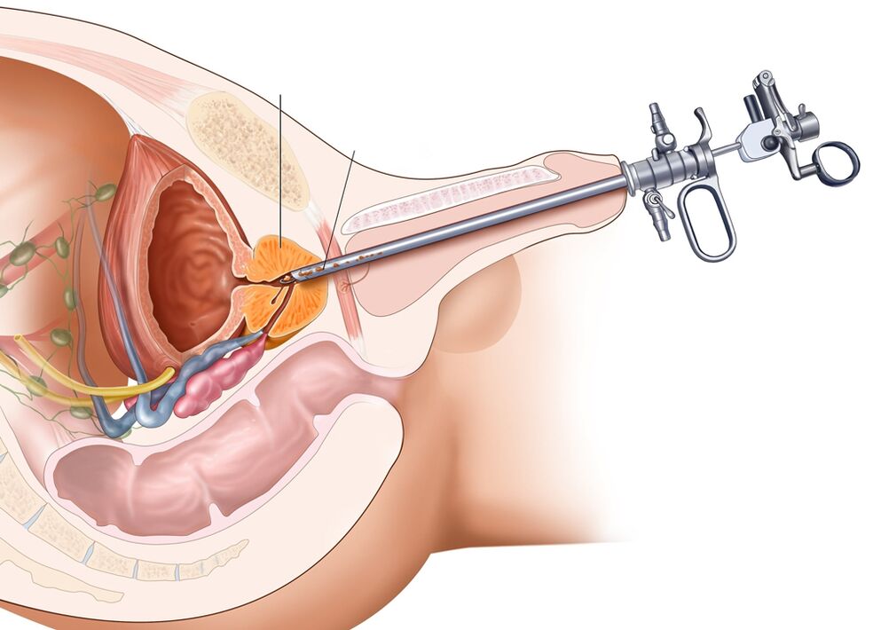 Transurethral Resektioun vun der Prostata erlaabt Iech déi betroffenen Deeler vum Organ ze entfernen