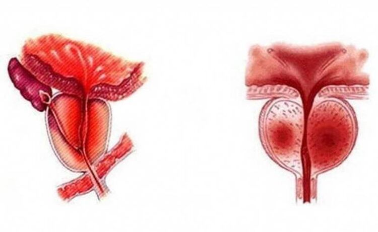 Akute Entzündung vun der Prostata, déi chronesch ka ginn