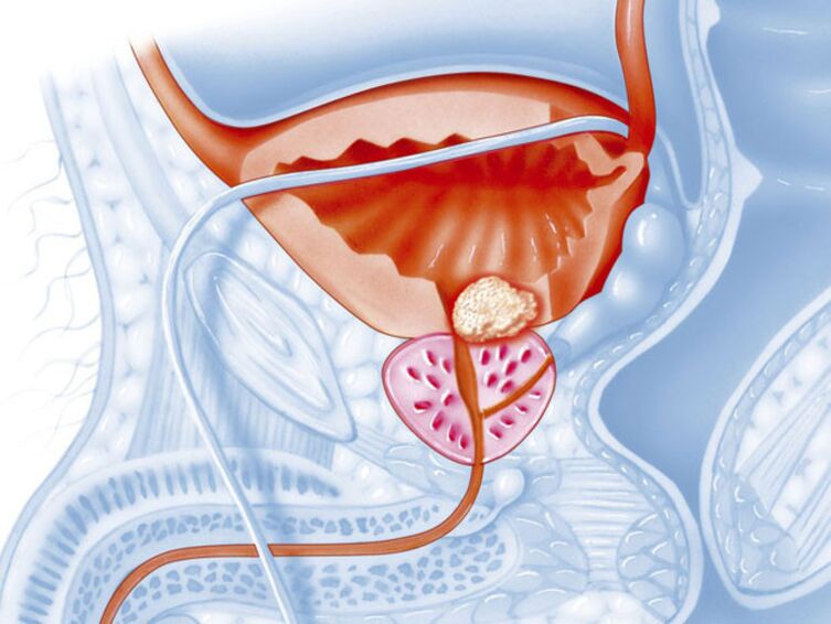 Bei chronescher Prostatitis verengt d'Lumen vun der Urethra, wat et schwéier mécht fir den Urin eraus ze fléien. 